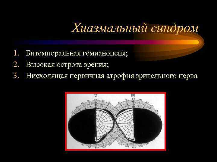     Хиазмальный синдром 1. Битемпоральная гемианопсия; 2. Высокая острота зрения; 3.