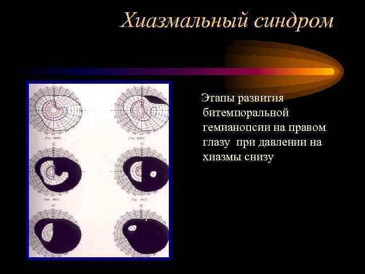 Хиазмальный синдром   Этапы развития  битемпоральной  гемианопсии на правом  глазу