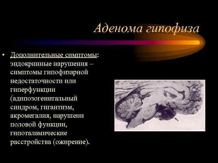     Аденома гипофиза • Дополнительные симптомы:  эндокринные нарушения – 