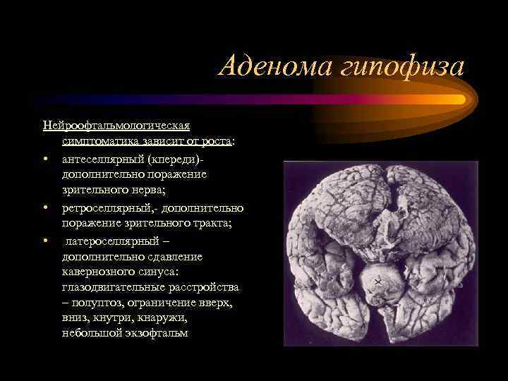       Аденома гипофиза Нейроофтальмологическая  симптоматика зависит от роста: