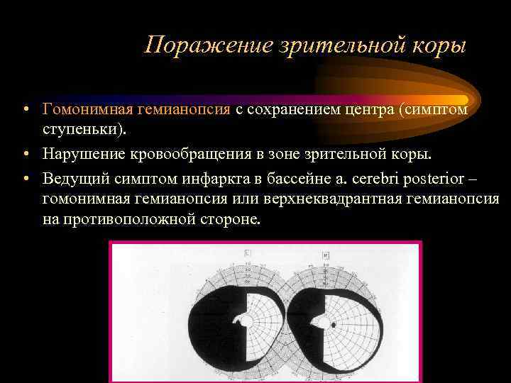     Поражение зрительной коры  • Гомонимная гемианопсия с сохранением центра