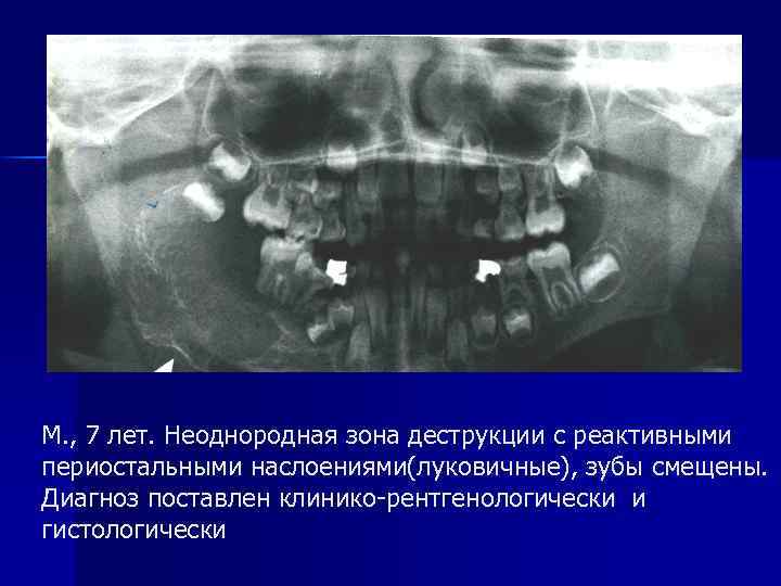 М. , 7 лет. Неоднородная зона деструкции с реактивными периостальными наслоениями(луковичные), зубы смещены. Диагноз