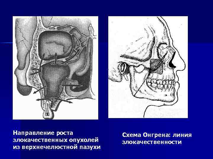 Направление роста злокачественных опухолей из верхнечелюстной пазухи Схема Онгрена: линия злокачественности 