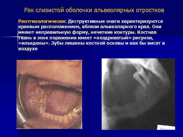 Рак слизистой оболочки альвеолярных отростков Рентгенологически: Деструктивные очаги характеризуются краевым расположением, вблизи альвеолярного края.