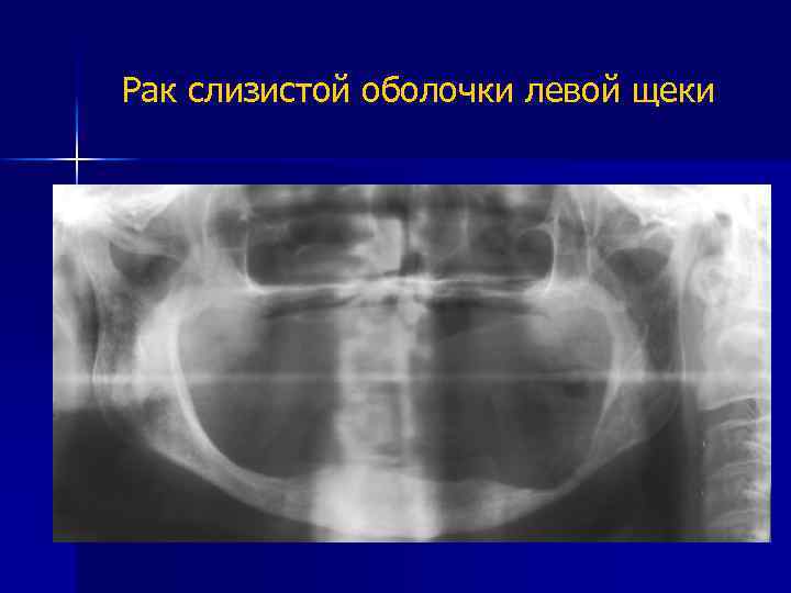 Рак слизистой оболочки левой щеки 