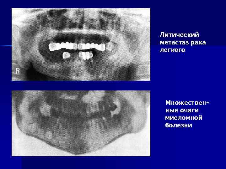 Литический метастаз рака легкого Множественные очаги миеломной болезни 