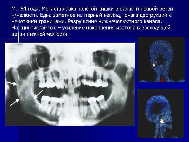 М. , 64 года. Метастаз рака толстой кишки в области правой ветви н/челюсти. Едва