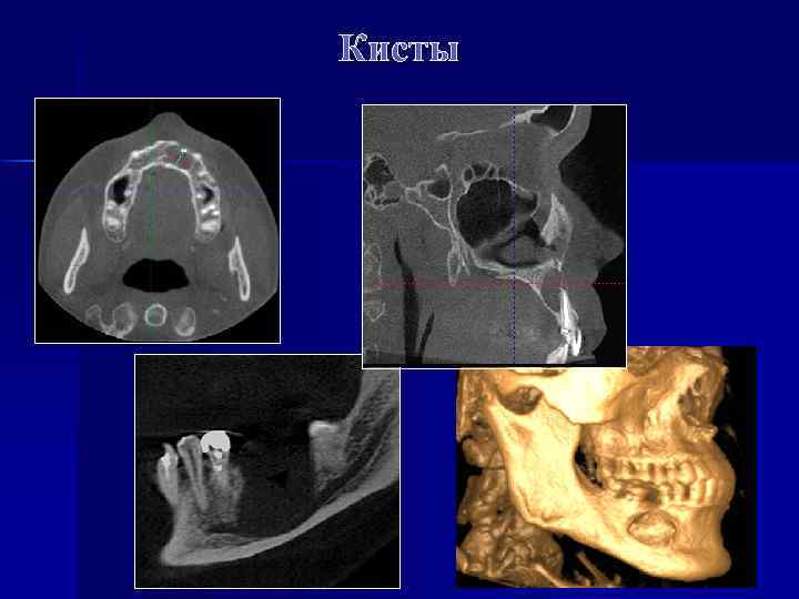 Кисты 