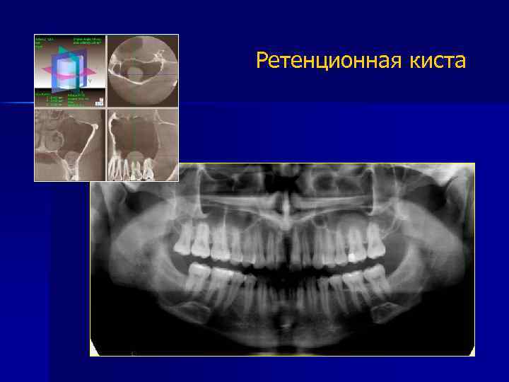 Ретенционная киста 