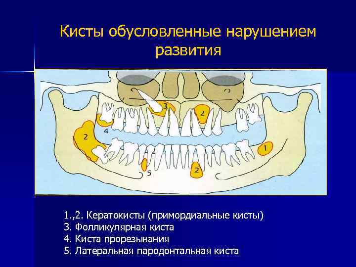 Неодонтогенные кисты презентация