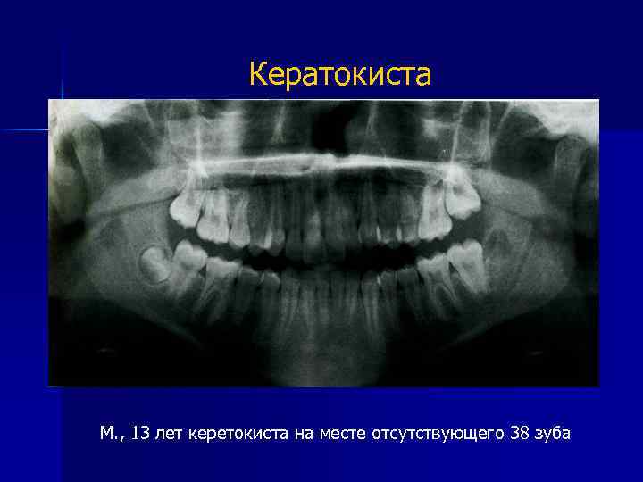 Кератокиста М. , 13 лет керетокиста на месте отсутствующего 38 зуба 