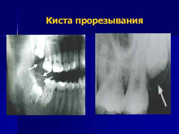 Киста прорезывания 