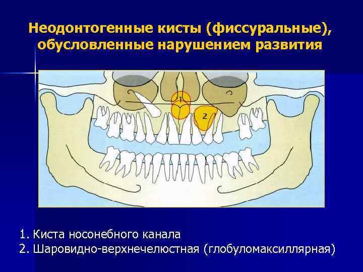 Неодонтогенные кисты презентация