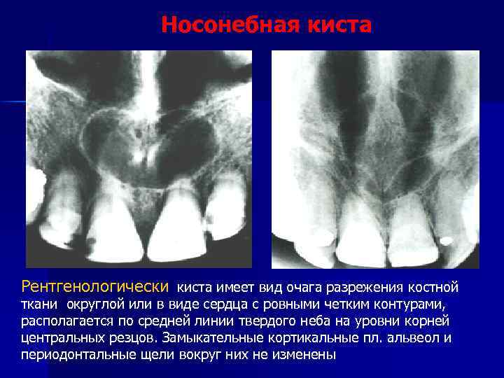 Носонебная киста Рентгенологически киста имеет вид очага разрежения костной ткани округлой или в виде