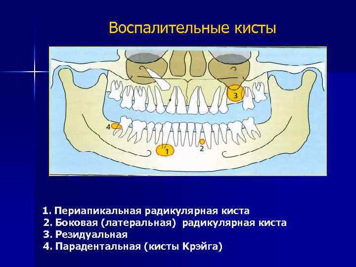 Резидуальная киста