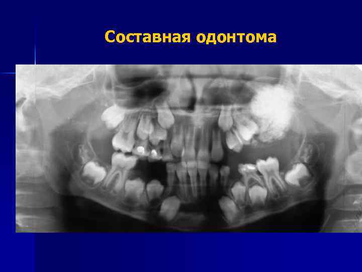 Составная одонтома 