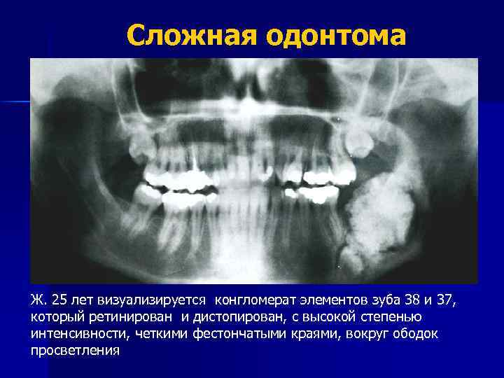 Клиническая картина сложной и составной одонтомы характеризуется