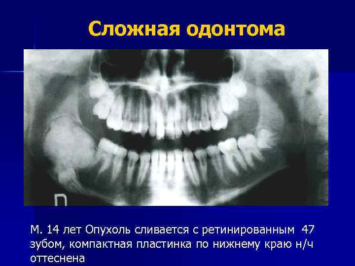 Клиническая картина сложной и составной одонтомы характеризуется