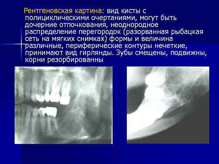 Рентгеновская картина: вид кисты с полициклическими очертаниями, могут быть дочерние отпочкования, неоднородное распределение перегородок