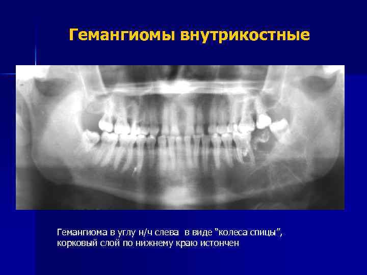 Гемангиомы внутрикостные Гемангиома в углу н/ч слева в виде “колеса спицы”, корковый слой по