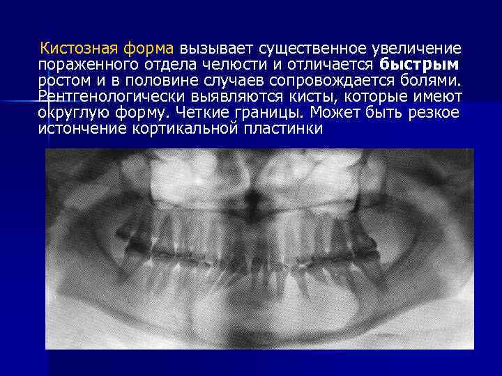 Неодонтогенные кисты презентация