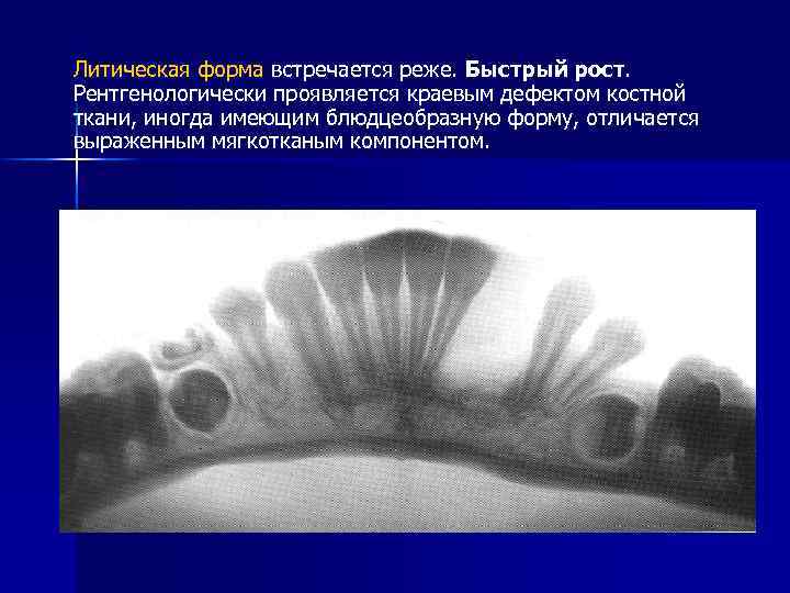 Литическая форма встречается реже. Быстрый рост. Рентгенологически проявляется краевым дефектом костной ткани, иногда имеющим