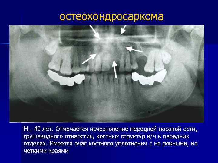 остеохондросаркома М. , 40 лет. Отмечается исчезновение передней носовой ости, грушевидного отверстия, костных структур