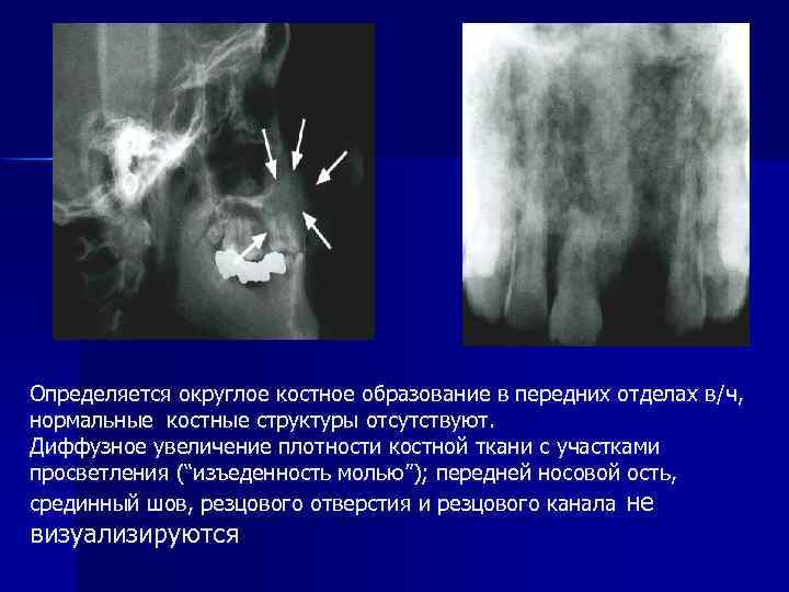 Определяется округлое костное образование в передних отделах в/ч, нормальные костные структуры отсутствуют. Диффузное увеличение