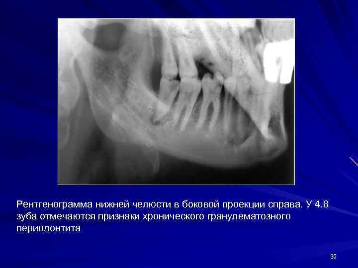 Рентгенограмма нижней челюсти в боковой проекции справа. У 4. 8 зуба отмечаются признаки хронического