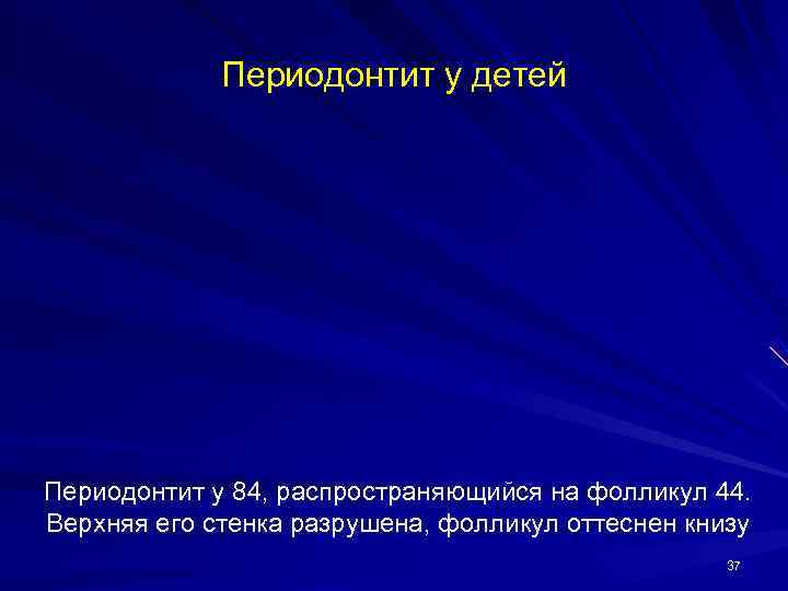    Периодонтит у детей Периодонтит у 84, распространяющийся на фолликул 44. Верхняя