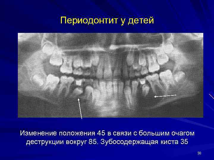 Профилактика кисты