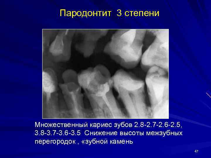   Пародонтит 3 степени Множественный кариес зубов 2. 8 -2. 7 -2. 6