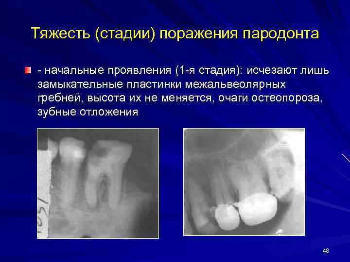 Тяжесть (стадии) поражения пародонта - начальные проявления (1 -я стадия): исчезают лишь замыкательные пластинки