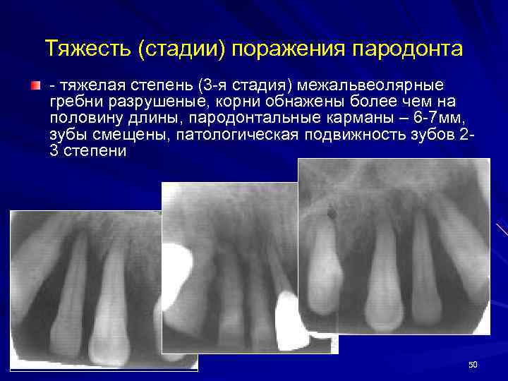 Тяжесть (стадии) поражения пародонта - тяжелая степень (3 -я стадия) межальвеолярные гребни разрушеные, корни