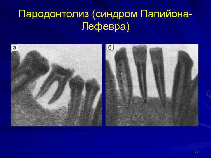 Пародонтолиз (синдром Папийона-  Лефевра)    56 