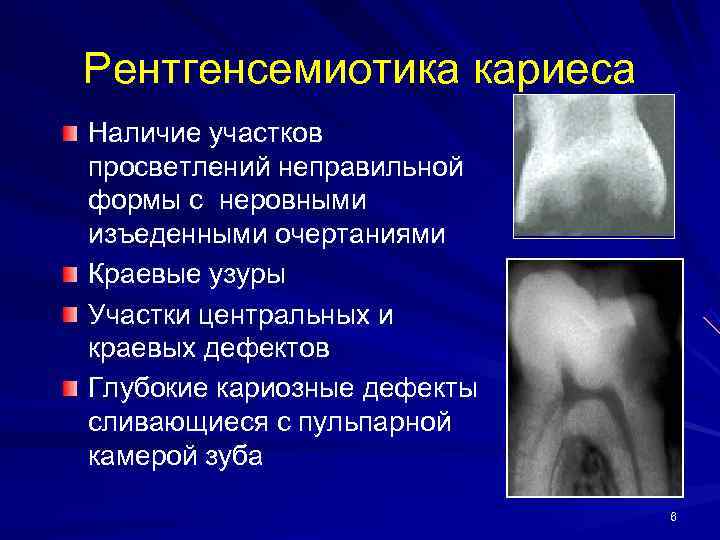 Рентгенсемиотика кариеса Наличие участков просветлений неправильной формы с неровными изъеденными очертаниями Краевые узуры Участки