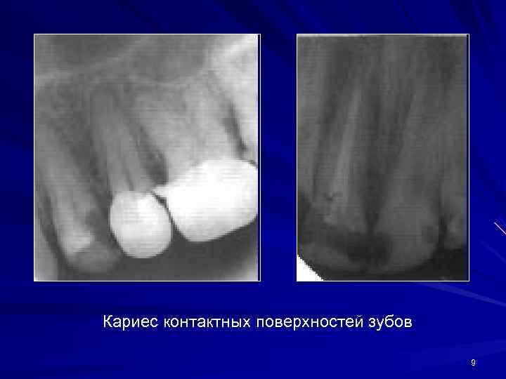 Кариес контактных поверхностей зубов       9 