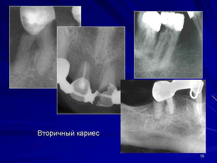 Вторичный кариес     10 