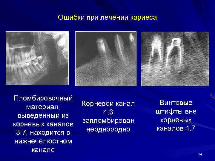   Ошибки при лечении кариеса Пломбировочный     Корневой канал 