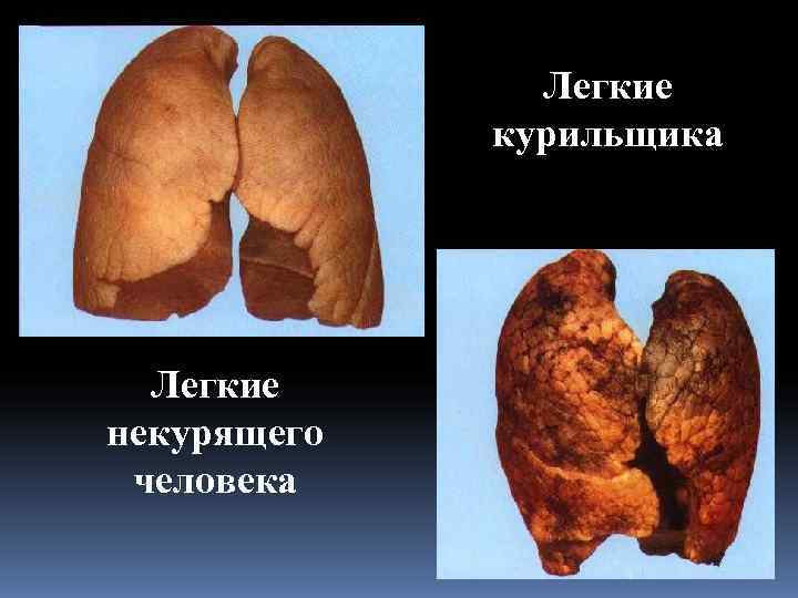     Легкие   курильщика  Легкие некурящего человека 