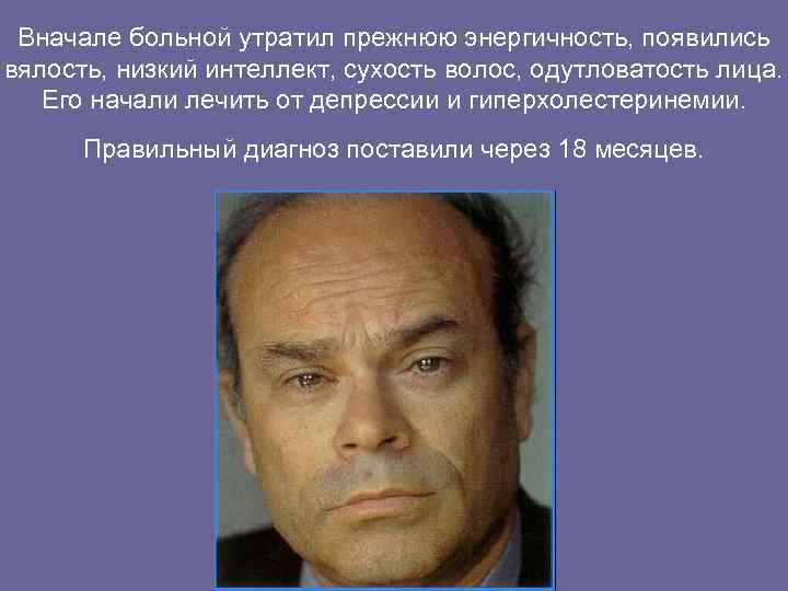 Вначале больной утратил прежнюю энергичность, появились вялость, низкий интеллект, сухость волос, одутловатость лица.