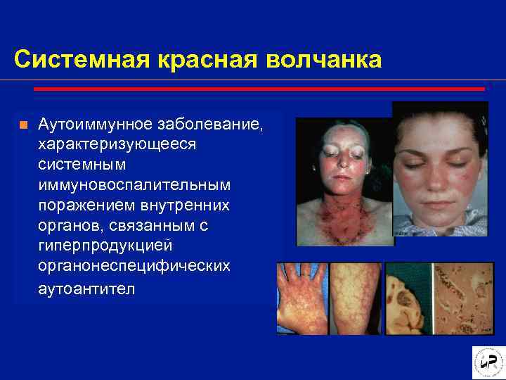 Системная красная волчанка n  Аутоиммунное заболевание, характеризующееся системным иммуновоспалительным поражением внутренних органов, связанным