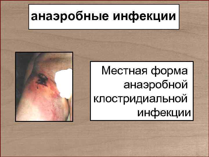 анаэробные инфекции   Местная форма   анаэробной   клостридиальной  