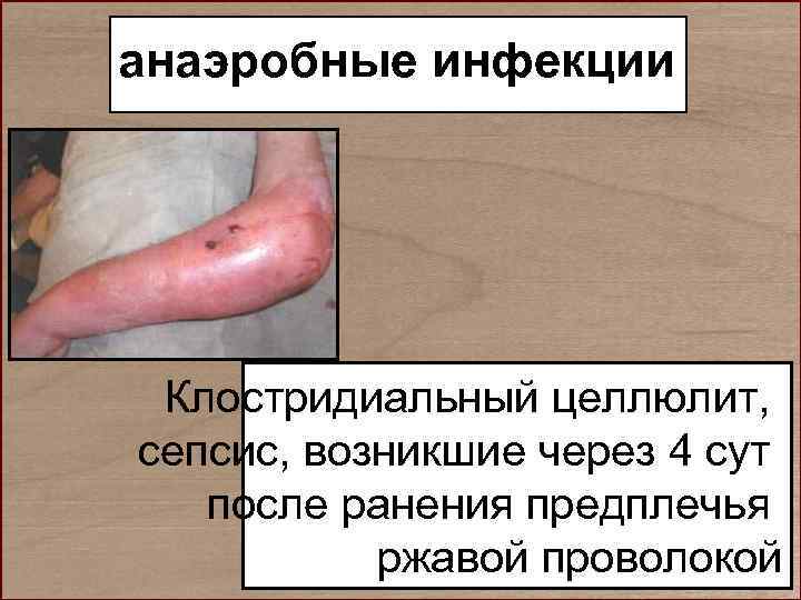 анаэробные инфекции Клостридиальный целлюлит, сепсис, возникшие через 4 сут  после ранения предплечья 