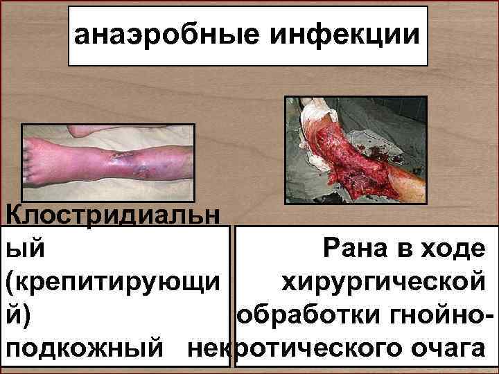   анаэробные инфекции Клостридиальн ый   Рана в ходе (крепитирующи  хирургической