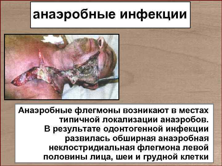   анаэробные инфекции Анаэробные флегмоны возникают в местах   типичной локализации анаэробов.