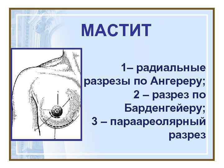 МАСТИТ   1– радиальные разрезы по Ангереру;  2 – разрез по 