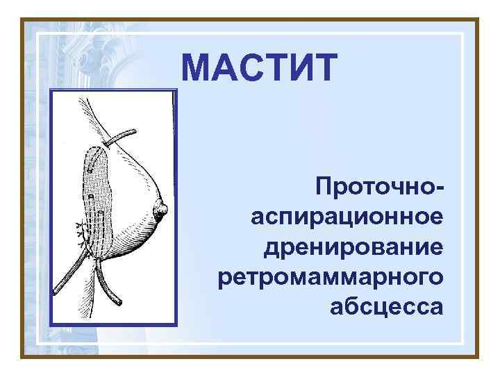 МАСТИТ  Проточно-  аспирационное дренирование ретромаммарного   абсцесса 