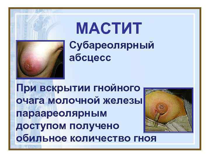    МАСТИТ   Субареолярный   абсцесс При вскрытии гнойного очага