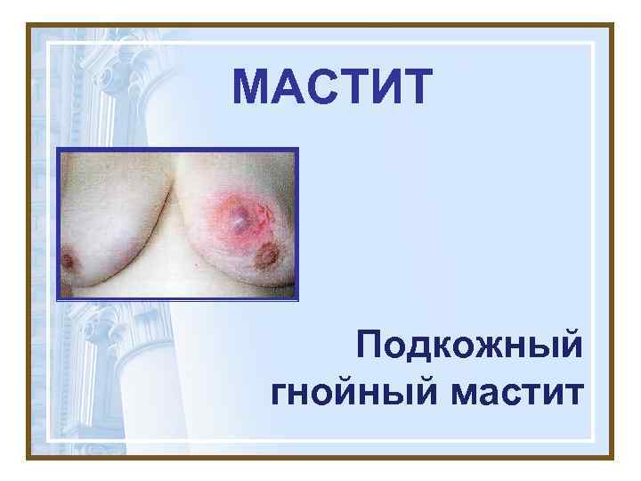 МАСТИТ   Подкожный гнойный мастит 